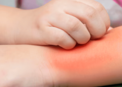 Alergia a picadas de mosquitos - Consulta com alergia botafogo